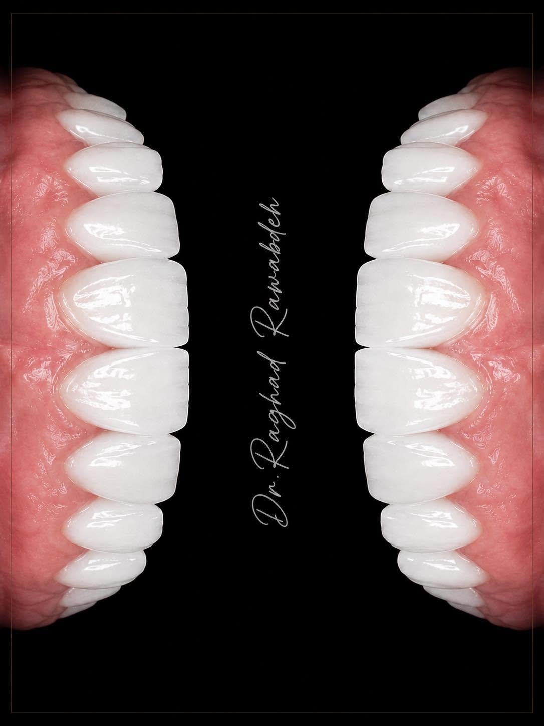 Hollywood Smile Design