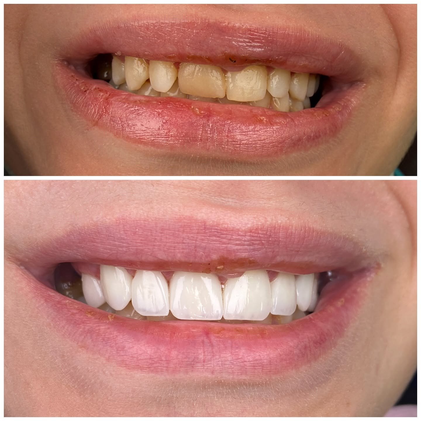 Zircon crowns before after case