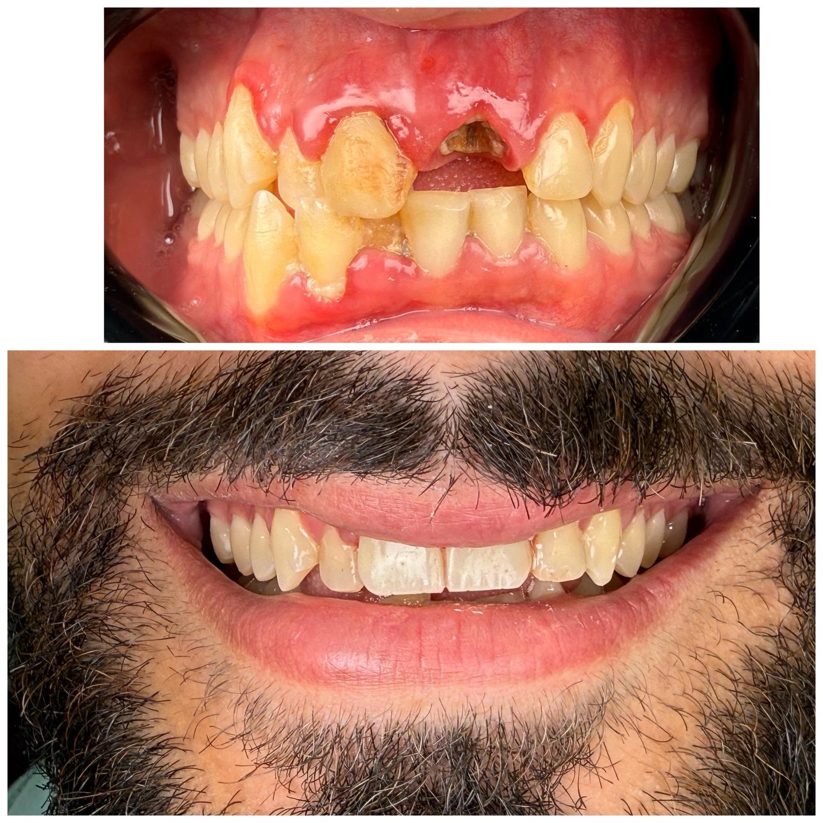 Teeth whitening before after case