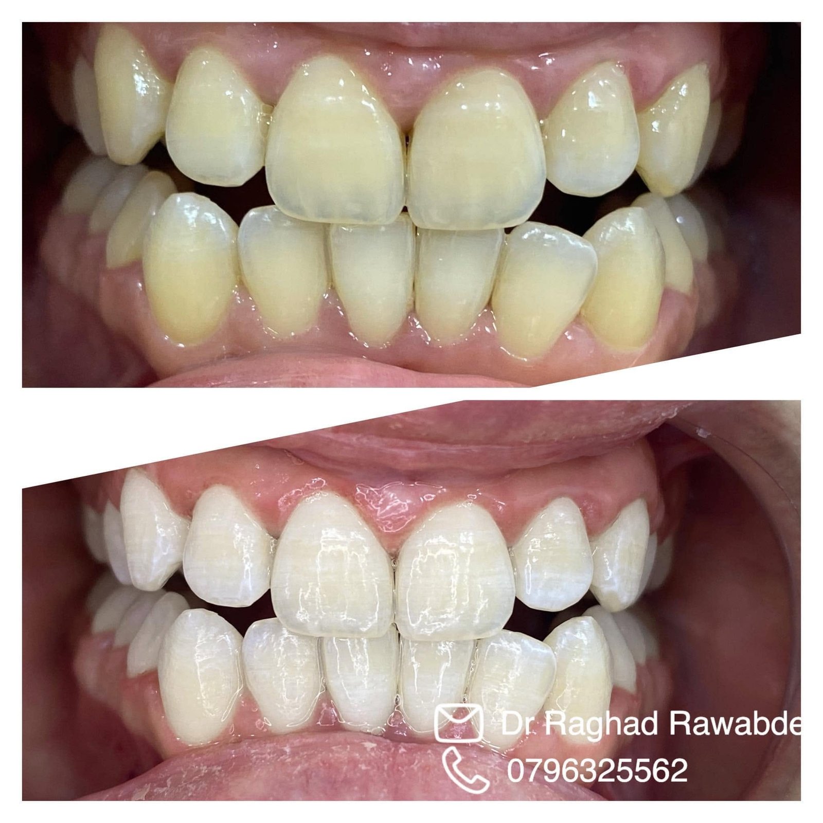 Broken tooth cosmetic restoration before after