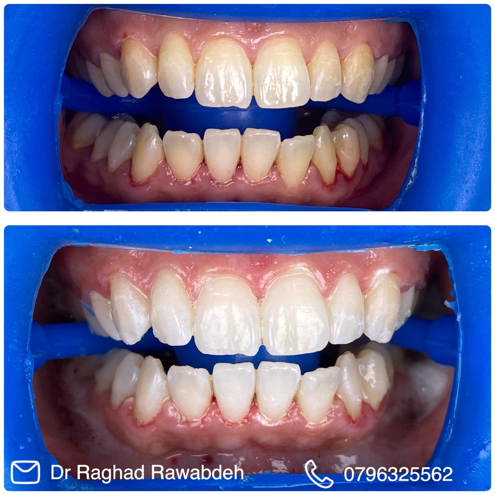 Broken tooth cosmetic restoration before after